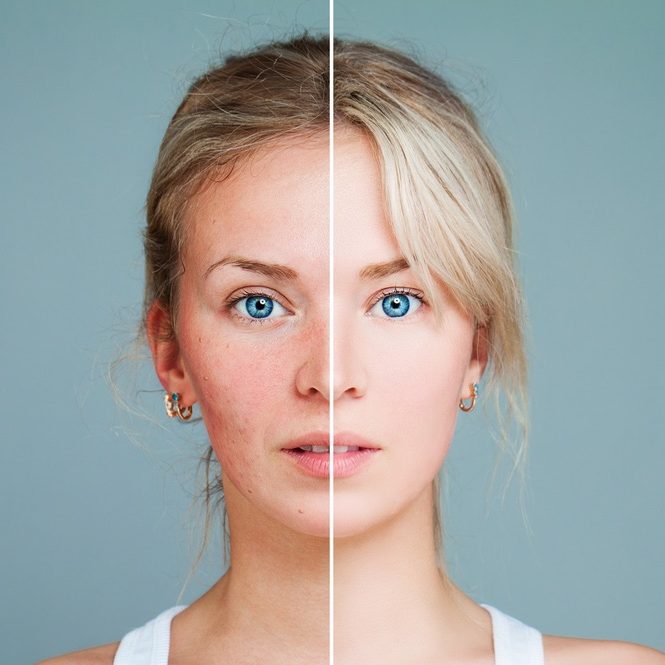IPL Skin Treatments