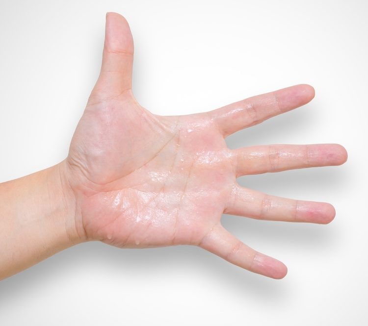 Excessive Sweating